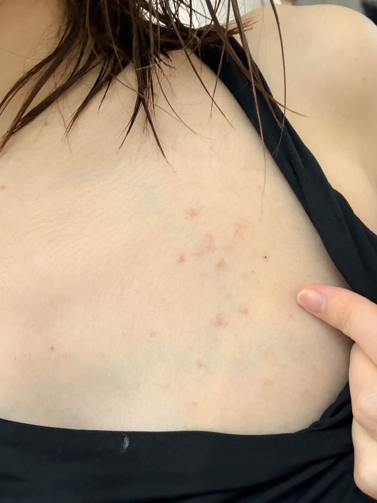 妊娠性痒疹胸元にできた写真